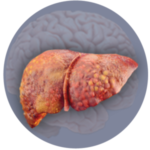 Overt Hepatic Encephalopathy (HE)